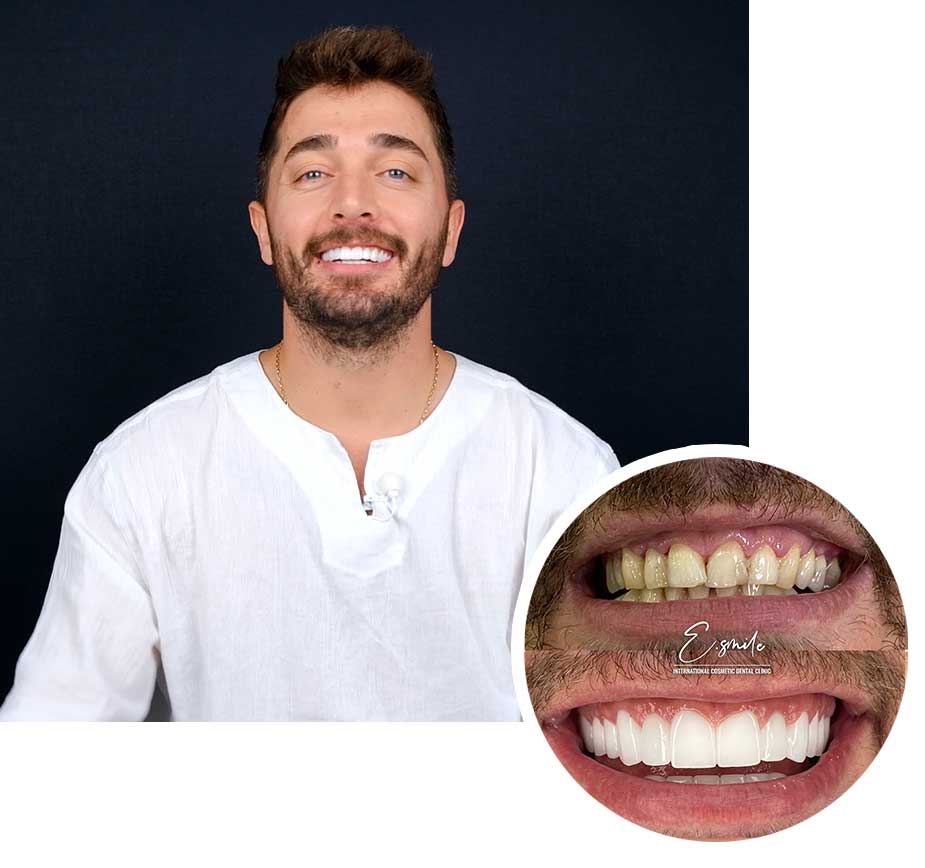 smile-before-after-male